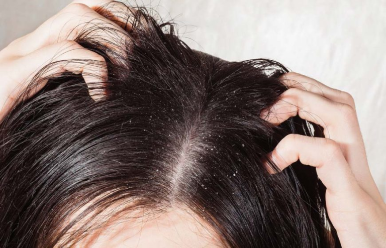 Reveling in Dandruff and Itchy Scalp Enigmas